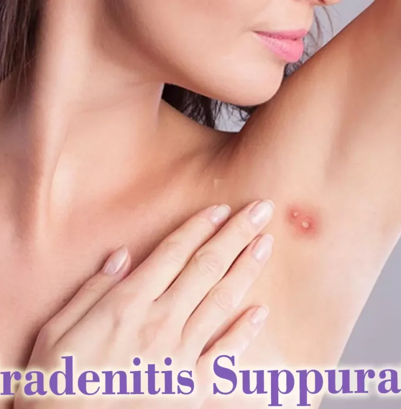 135716-hidradenitis-suppurativa2