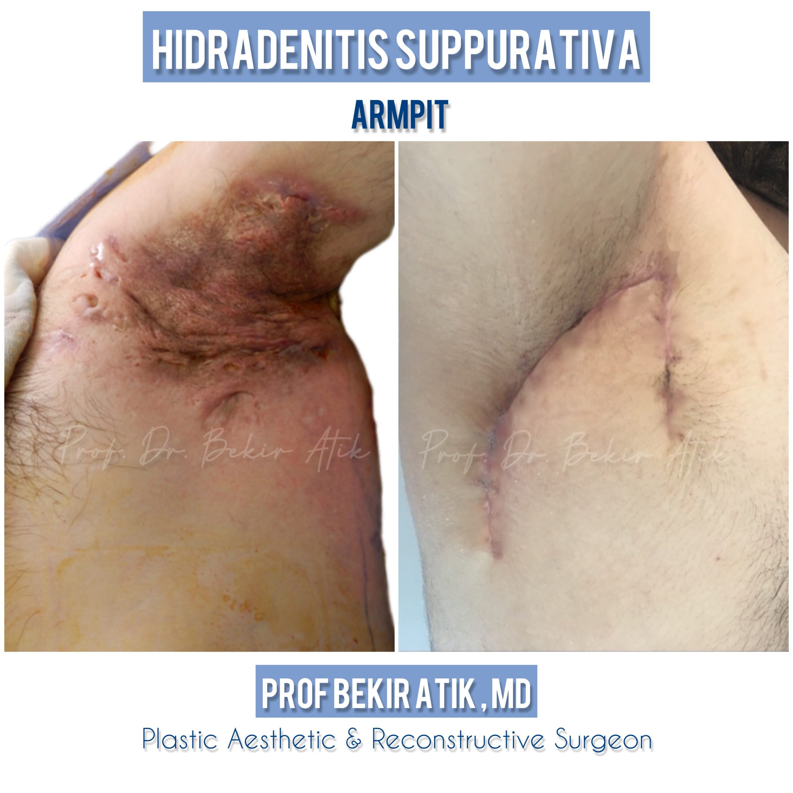 hidradenitis suppurativa surgery